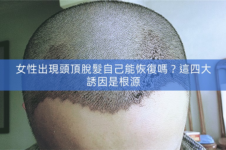 女性出現頭頂脫髮自己能恢復嗎？這四大誘因是根源