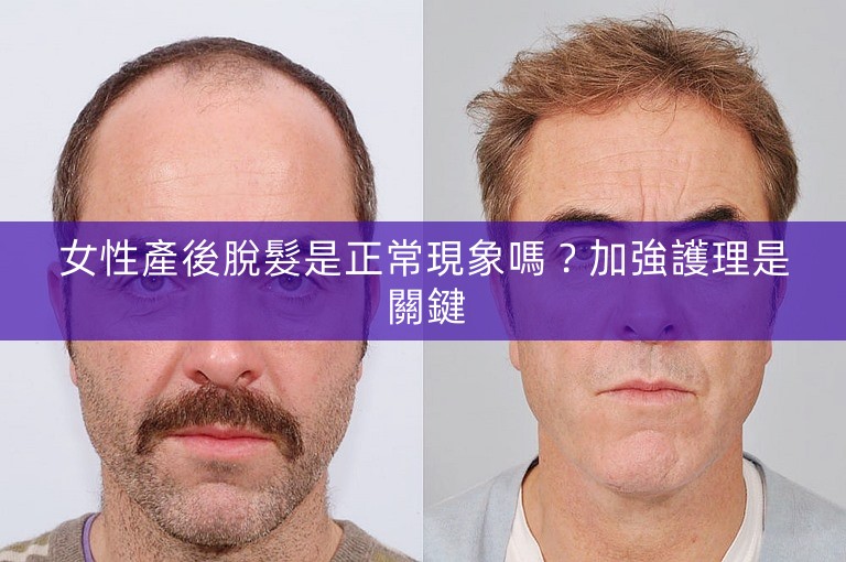女性產後脫髮是正常現象嗎？加強護理是關鍵