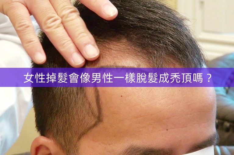 女性掉髮會像男性一樣脫髮成禿頂嗎？