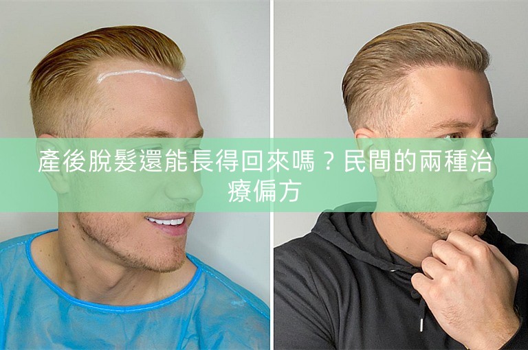 產後脫髮還能長得回來嗎？民間的兩種治療偏方