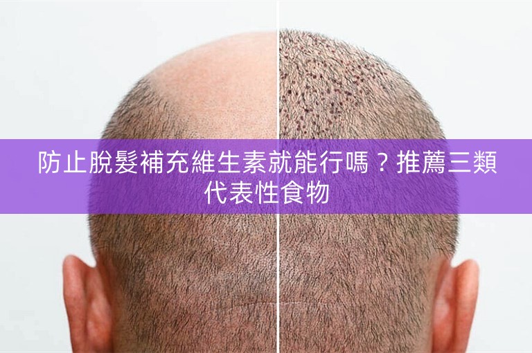 防止脫髮補充維生素就能行嗎？推薦三類代表性食物