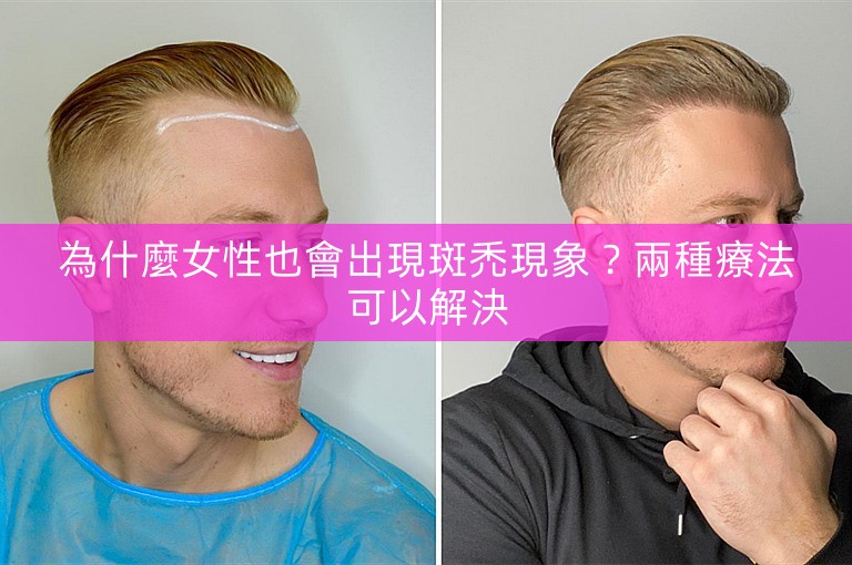 為什麼女性也會出現斑禿現象？兩種療法可以解決