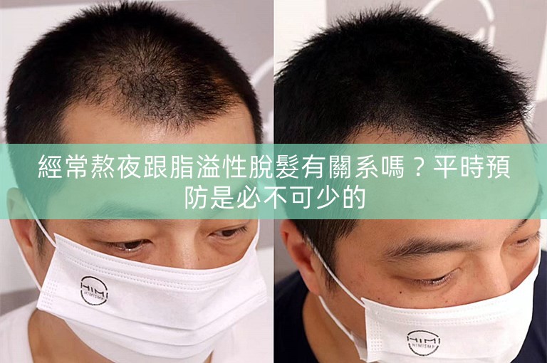經常熬夜跟脂溢性脫髮有關系嗎？平時預防是必不可少的