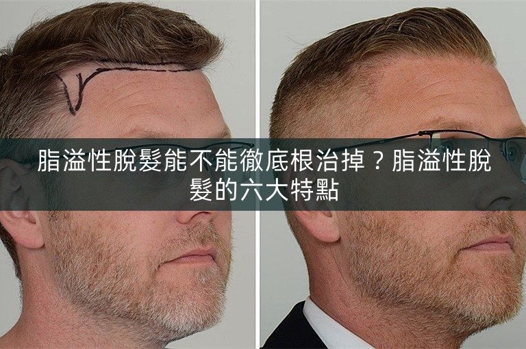 脂溢性脫髮能不能徹底根治掉？脂溢性脫髮的六大特點