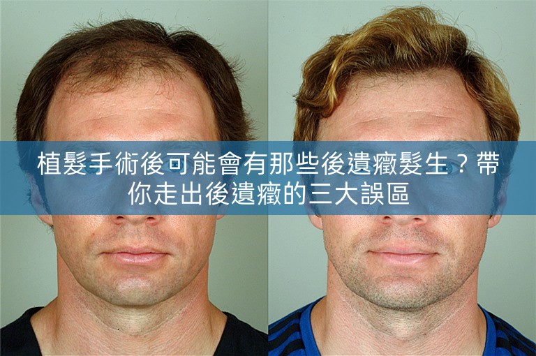 植髮手術後可能會有那些後遺癥髮生？帶你走出後遺癥的三大誤區