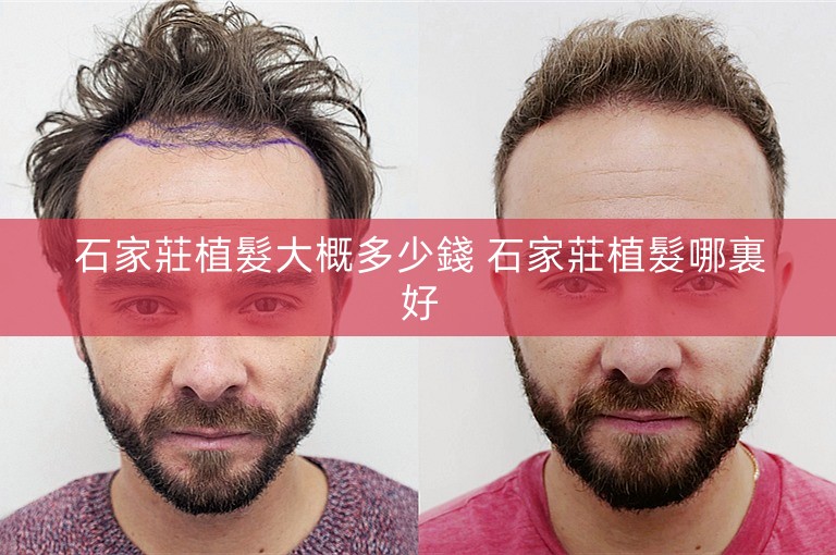 石家莊植髮大概多少錢 石家莊植髮哪裏好