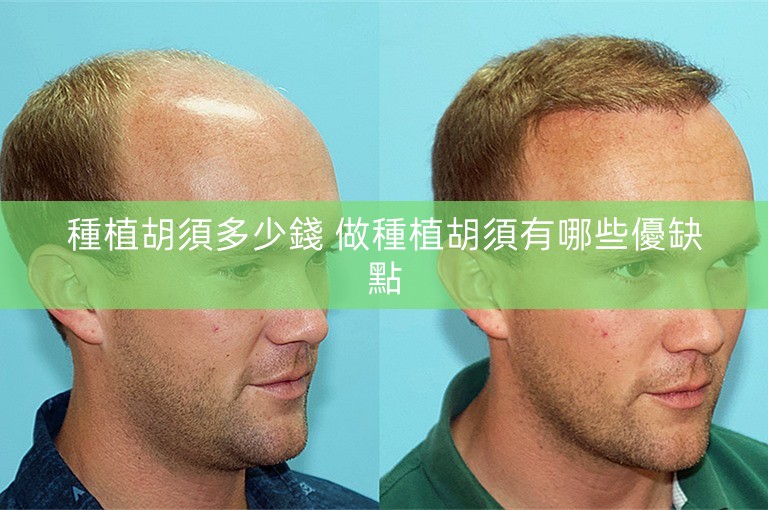 種植胡須多少錢 做種植胡須有哪些優缺點 種植胡須多少錢 做種植胡須有哪些優缺點