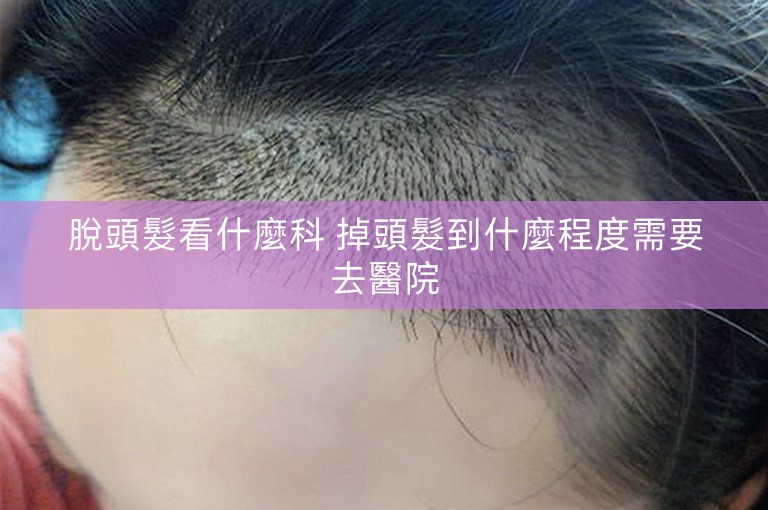 脫頭髮看什麼科 掉頭髮到什麼程度需要去醫院
