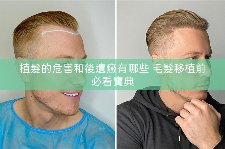 植髮的危害和後遺癥有哪些 毛髮移植前必看寶典