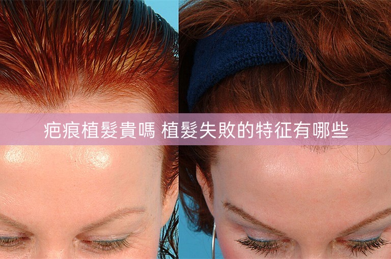 疤痕植髮貴嗎 植髮失敗的特征有哪些