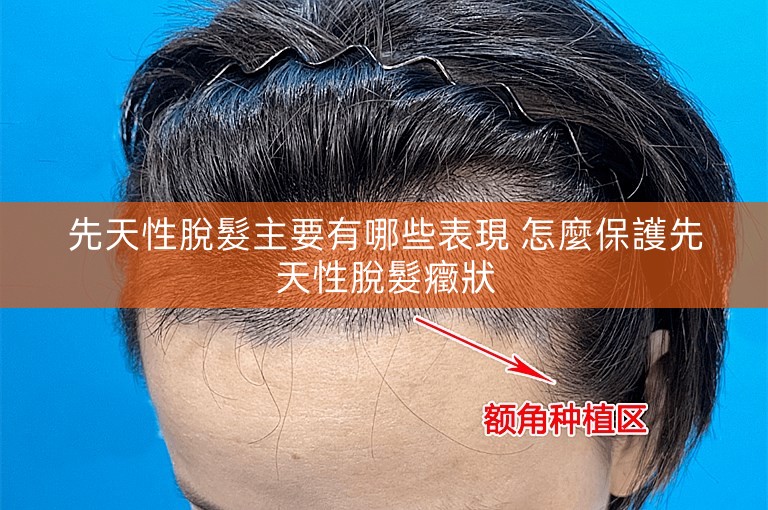 先天性脫髮主要有哪些表現 怎麼保護先天性脫髮癥狀