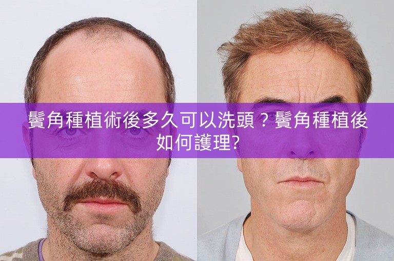 鬢角種植術後多久可以洗頭？鬢角種植後如何護理?