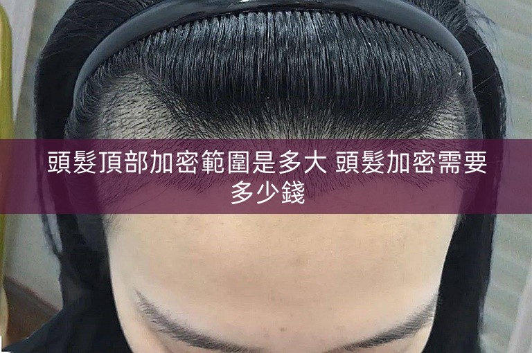 頭髮頂部加密範圍是多大 頭髮加密需要多少錢