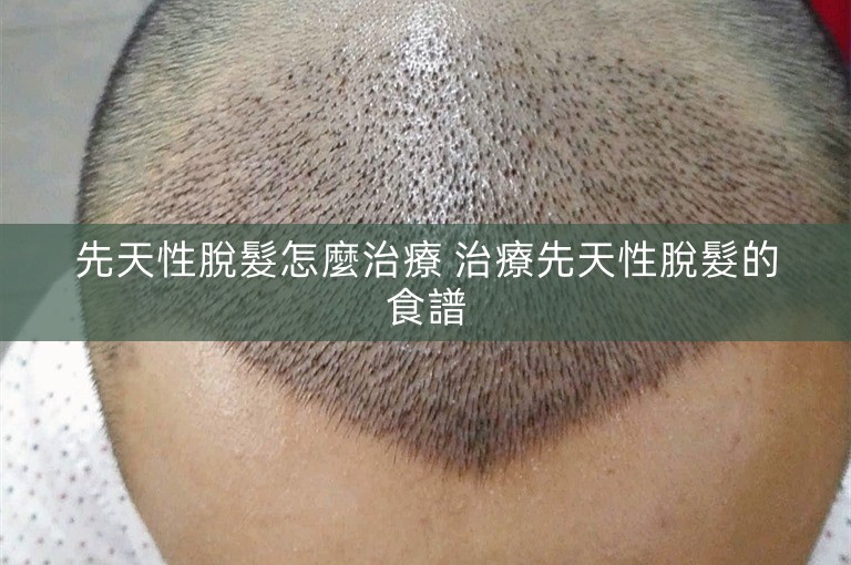 先天性脫髮怎麼治療 治療先天性脫髮的食譜
