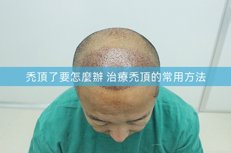 禿頂了要怎麼辦 治療禿頂的常用方法