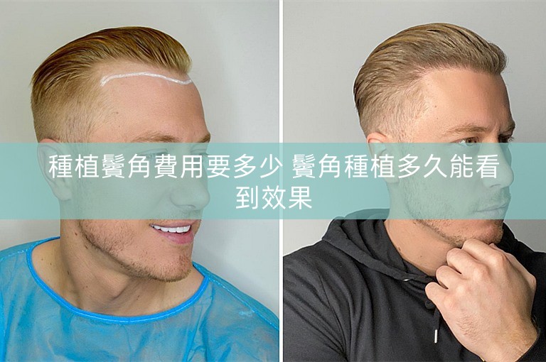 種植鬢角費用要多少 鬢角種植多久能看到效果