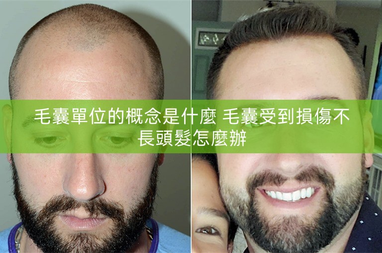 毛囊單位的概念是什麼 毛囊受到損傷不長頭髮怎麼辦