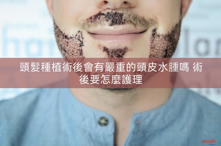 頭髮種植術後會有嚴重的頭皮水腫嗎 術後要怎麼護理