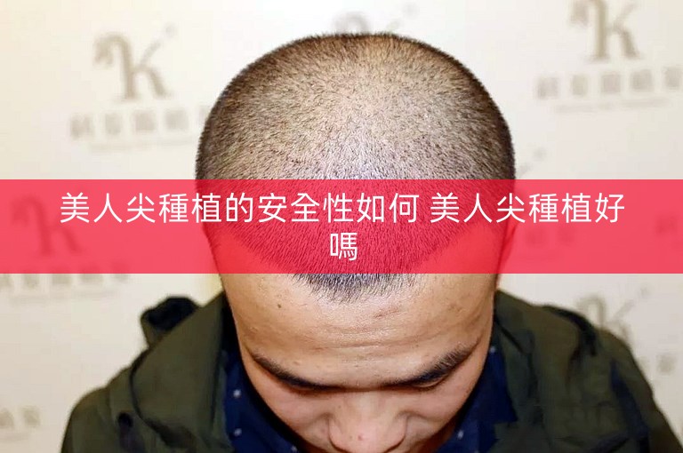 美人尖種植的安全性如何 美人尖種植好嗎