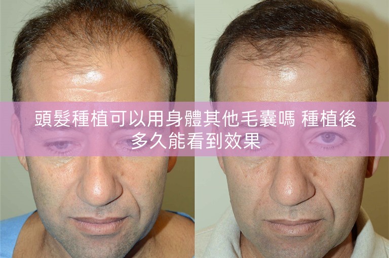頭髮種植可以用身體其他毛囊嗎 種植後多久能看到效果