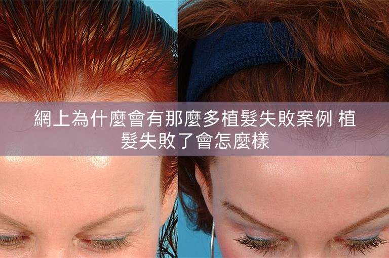 網上為什麼會有那麼多植髮失敗案例 植髮失敗了會怎麼樣