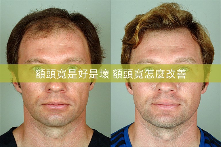 額頭寬是好是壞 額頭寬怎麼改善