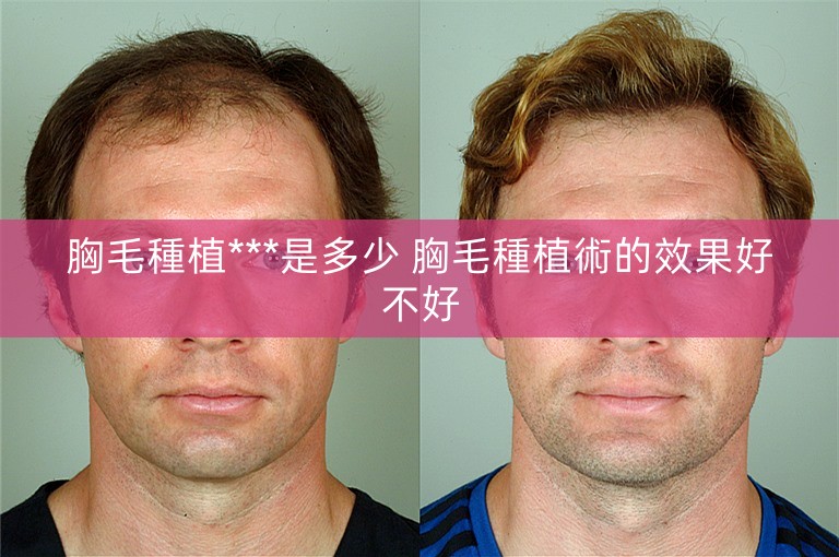 胸毛種植***是多少 胸毛種植術的效果好不好 胸毛種植***是多少 胸毛種植術的效果好不好