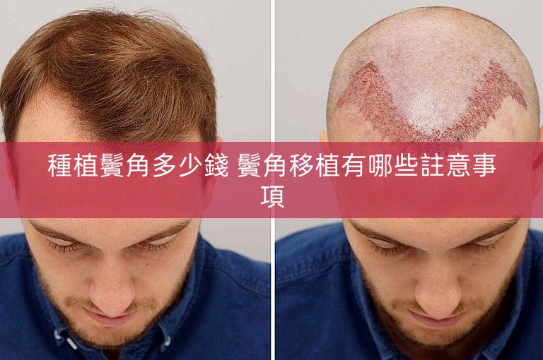 種植鬢角多少錢 鬢角移植有哪些註意事項
