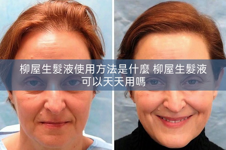 柳屋生髮液使用方法是什麼 柳屋生髮液可以天天用嗎