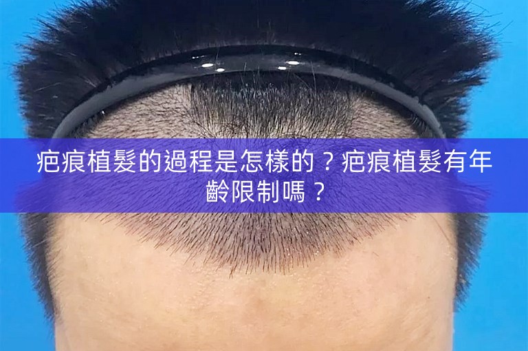 疤痕植髮的過程是怎樣的?疤痕植髮有年齡限制嗎? 疤痕植髮的過程是怎樣的?疤痕植髮有年齡限制嗎?
