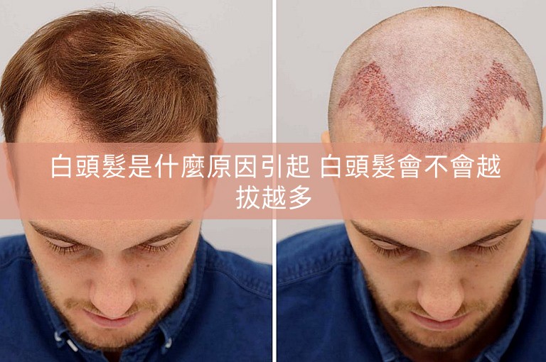 白頭髮是什麼原因引起 白頭髮會不會越拔越多