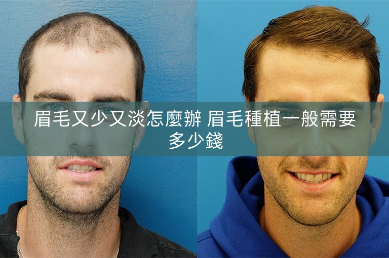 眉毛又少又淡怎麼辦 眉毛種植一般需要多少錢