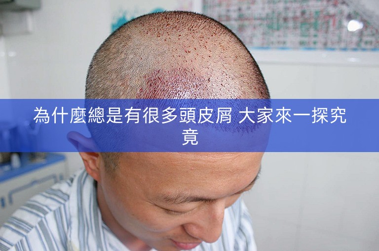 為什麼總是有很多頭皮屑 大家來一探究竟