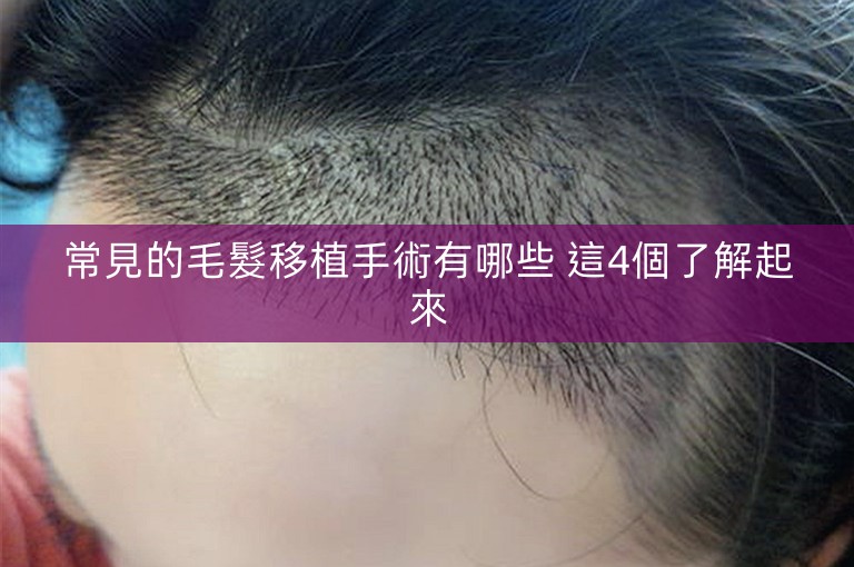 常見的毛髮移植手術有哪些 這4個了解起來 常見的毛髮移植手術有哪些 這4個了解起來