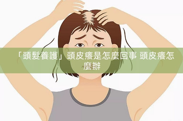 「頭髮養護」頭皮癢是怎麼回事 頭皮癢怎麼辦