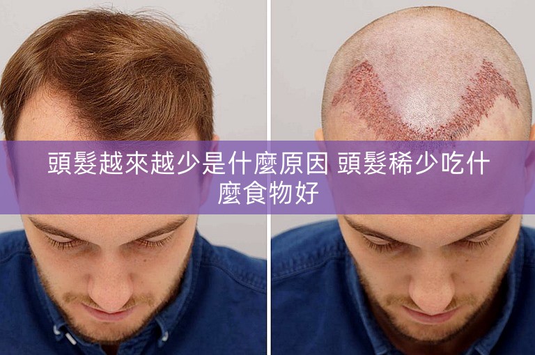 頭髮越來越少是什麼原因 頭髮稀少吃什麼食物好 頭髮越來越少是什麼原因 頭髮稀少吃什麼食物好