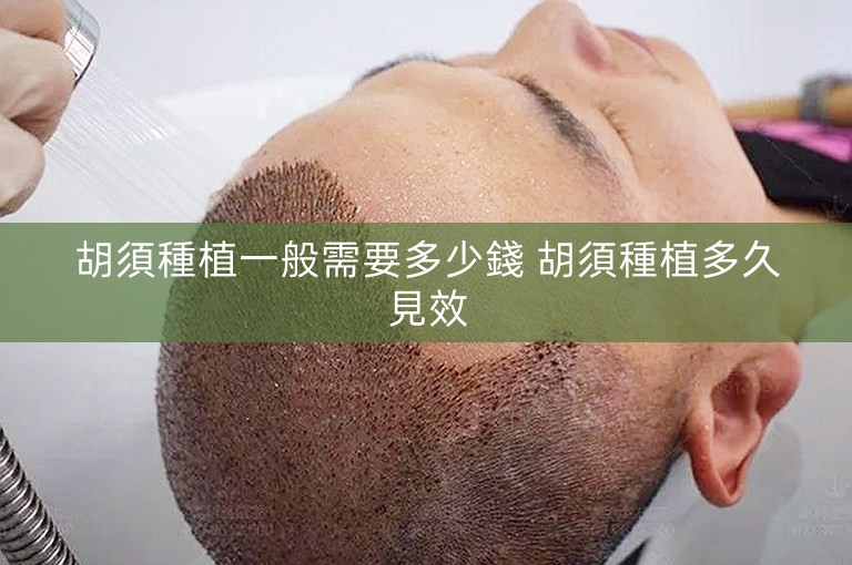 胡須種植一般需要多少錢 胡須種植多久見效 胡須種植一般需要多少錢 胡須種植多久見效