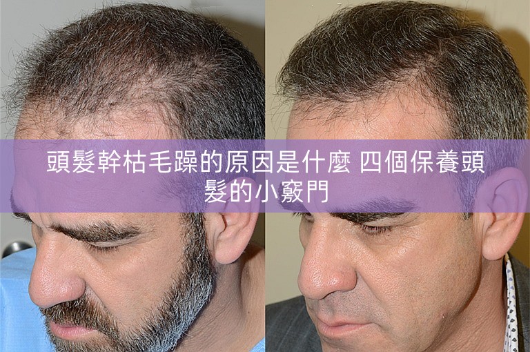 頭髮幹枯毛躁的原因是什麼 四個保養頭髮的小竅門