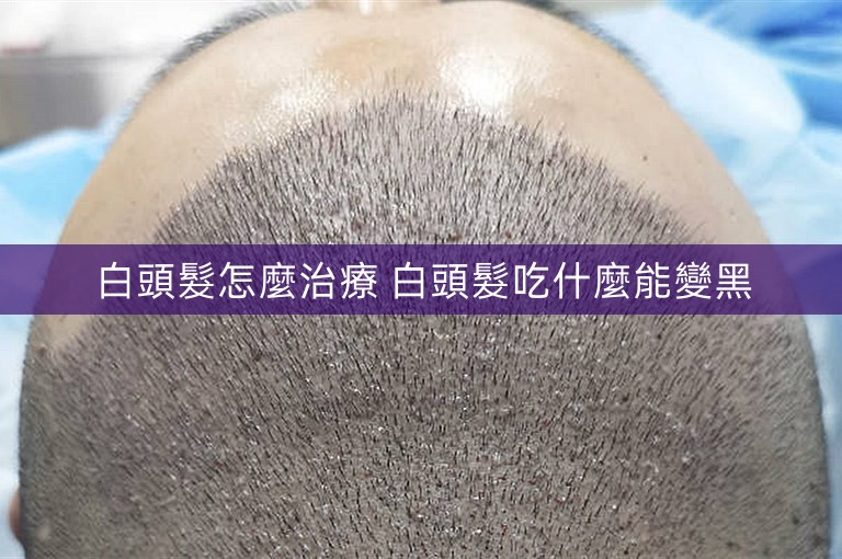 白頭髮怎麼治療 白頭髮吃什麼能變黑