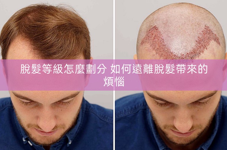 脫髮等級怎麼劃分 如何遠離脫髮帶來的煩惱