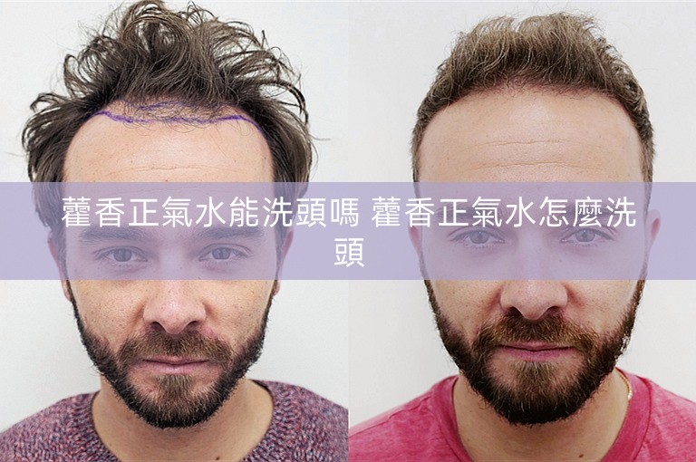 藿香正氣水能洗頭嗎 藿香正氣水怎麼洗頭
