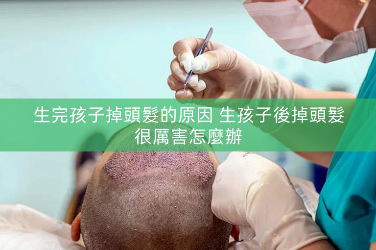 生完孩子掉頭髮的原因 生孩子後掉頭髮很厲害怎麼辦