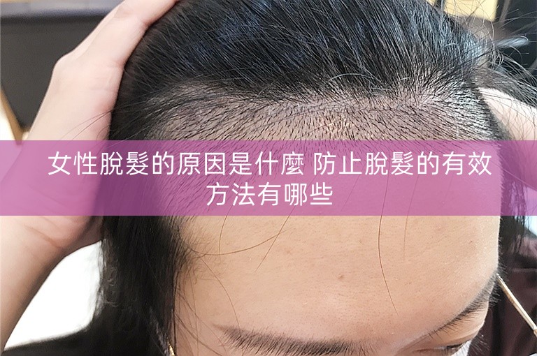 女性脫髮的原因是什麼 防止脫髮的有效方法有哪些