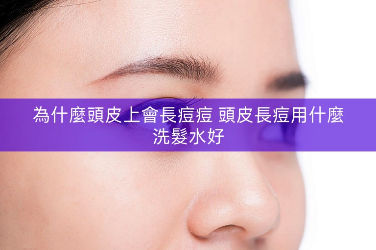 為什麼頭皮上會長痘痘 頭皮長痘用什麼洗髮水好