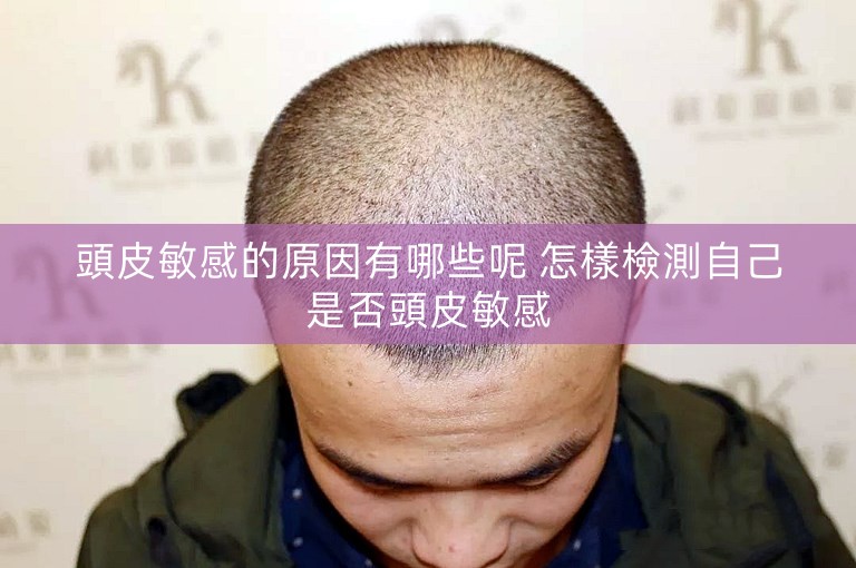 頭皮敏感的原因有哪些呢 怎樣檢測自己是否頭皮敏感