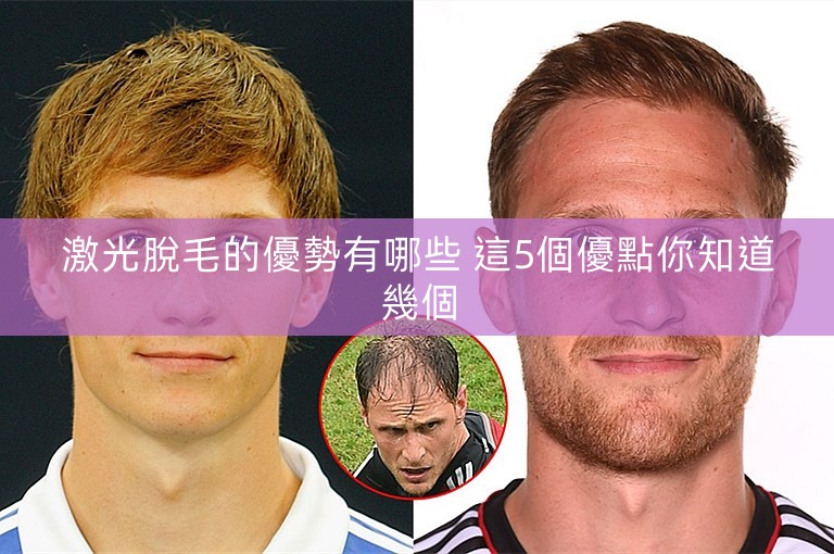 激光脫毛的優勢有哪些 這5個優點你知道幾個