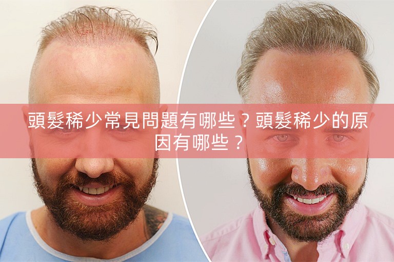 頭髮稀少常見問題有哪些？頭髮稀少的原因有哪些？