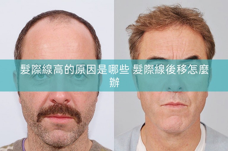 髮際線高的原因是哪些 髮際線後移怎麼辦 髮際線高的原因是哪些 髮際線後移怎麼辦
