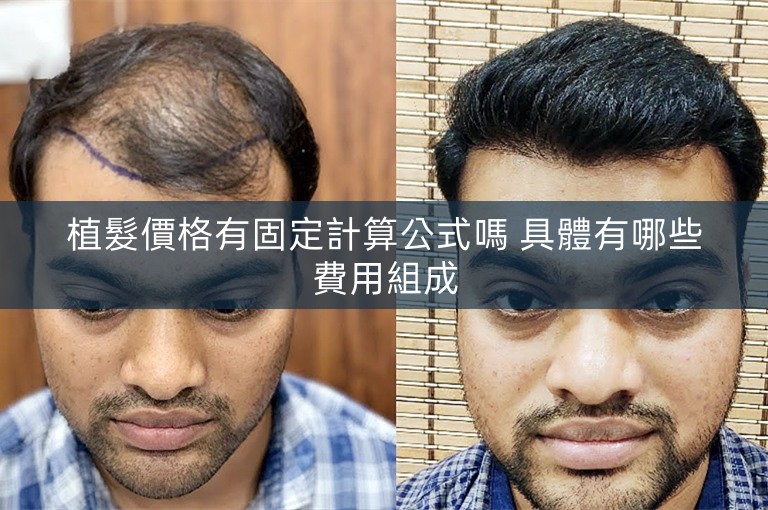 植髮價格有固定計算公式嗎 具體有哪些費用組成