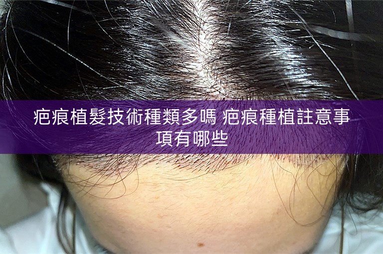 疤痕植髮技術種類多嗎 疤痕種植註意事項有哪些
